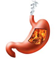 Acidez estomacal - Gastritis